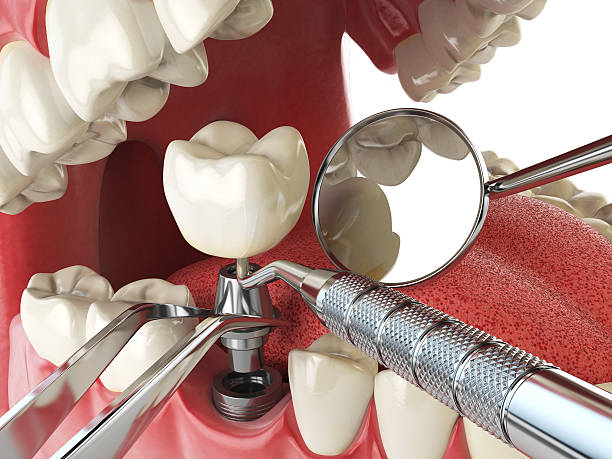Best Emergency Root Canal Treatment in Robertsde, AL